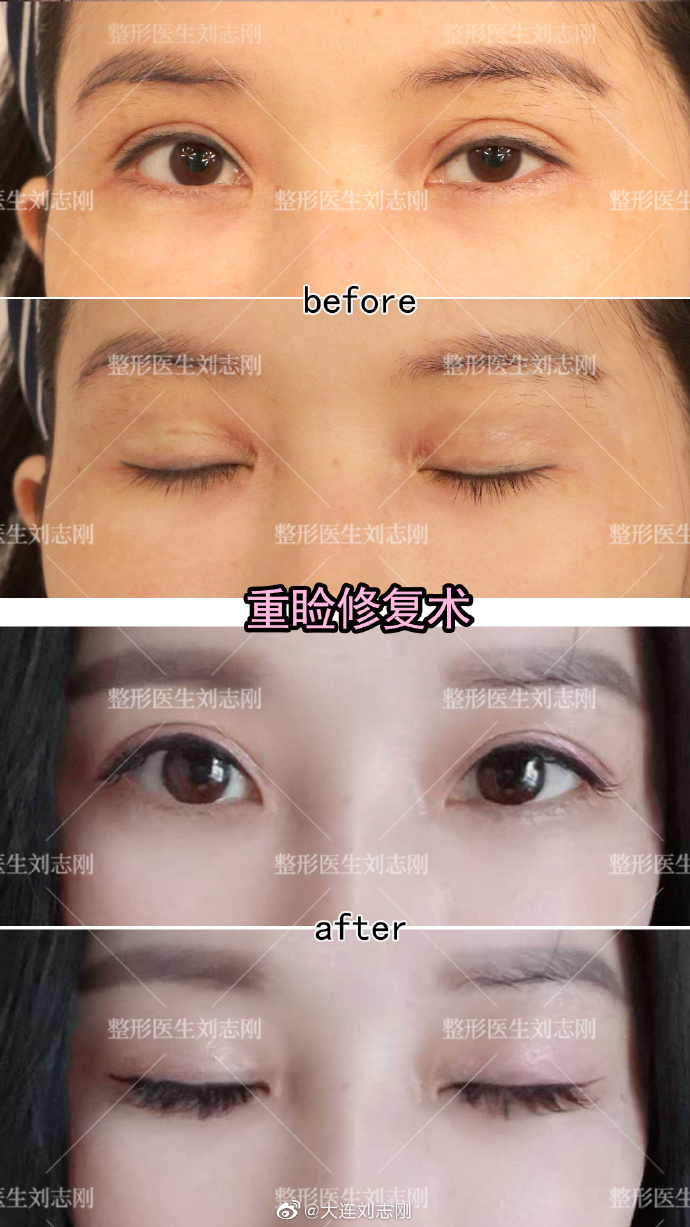 中国最好的眼修复专家：大连爱德丽格刘志刚双眼皮修复价格和案例