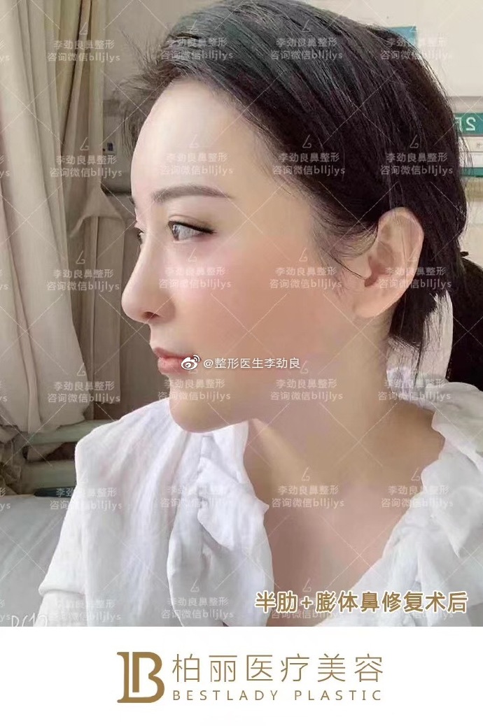 中国顶级鼻修复专家：北京刘彦军李劲良王军和李长赋哪个做鼻修复技术好？