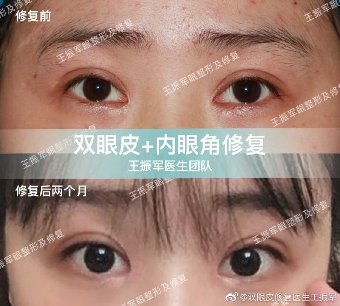 中国知名双眼皮修复专家：张冰洁和王振军哪个做双眼皮修复好？