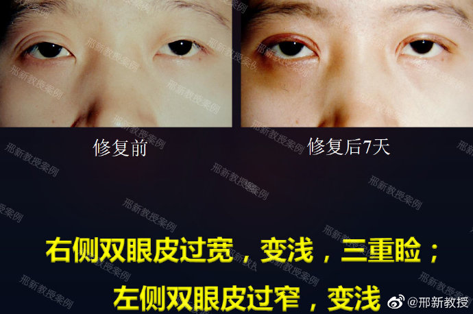 中国最好的顶尖双眼皮修复专家：邢新双眼皮修复案例和双眼皮修复收费评价