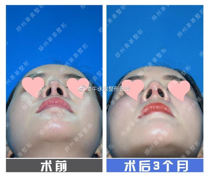 中国最好的鼻修复专家：上海王会勇和郑州牛永敢鼻修复哪个好？