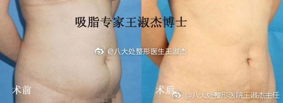 北京八大处谁填脂肪最厉害：王淑杰、李发成、顾云鹏脂肪填充哪个最好？