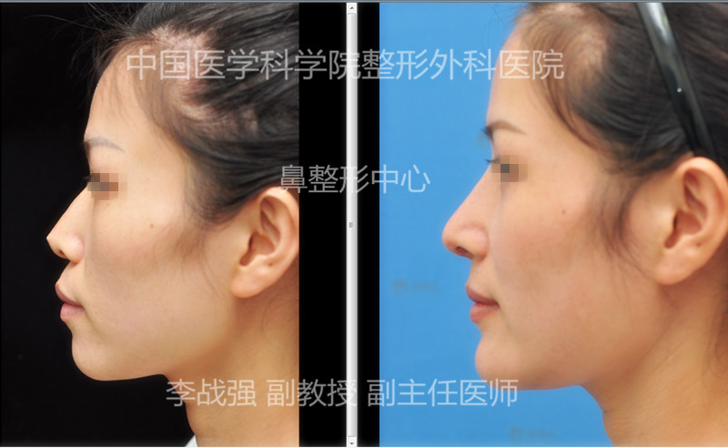 中国顶尖鼻修复专家推荐：北京李战强和李劲良谁做鼻子（隆鼻）好一些？
