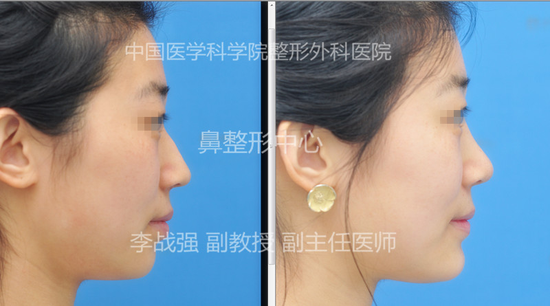 中国顶尖鼻修复专家推荐：北京李战强和李劲良谁做鼻子（隆鼻）好一些？