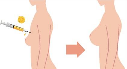 两个丰胸的方法：假体硅胶隆胸手术和脂肪移植丰胸谁更好？