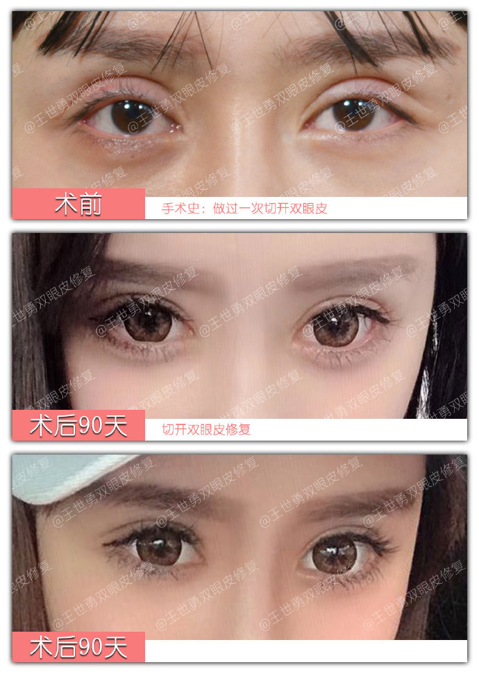 国内最好的双眼皮修复医生：靳小雷王世勇和韩勋哪个双眼皮修复好？