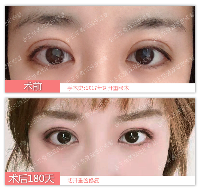北京双眼皮修复最好的专家：王世勇和靳小雷（案例预约价格）双眼皮修复谁厉害？