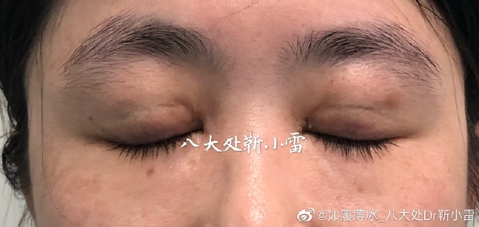 北京双眼皮修复最好的专家：王世勇和靳小雷（案例预约价格）双眼皮修复谁厉害？