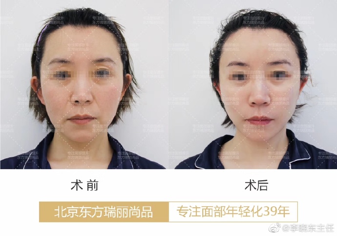 国内最好的顶尖面部提升年轻化专家：杨大平和李晓东谁的面部提升更好？