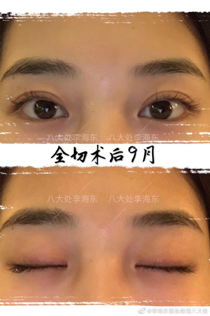 中国做双眼皮眼综合最好的专家：李海东和靳小雷哪个双眼皮做的好？