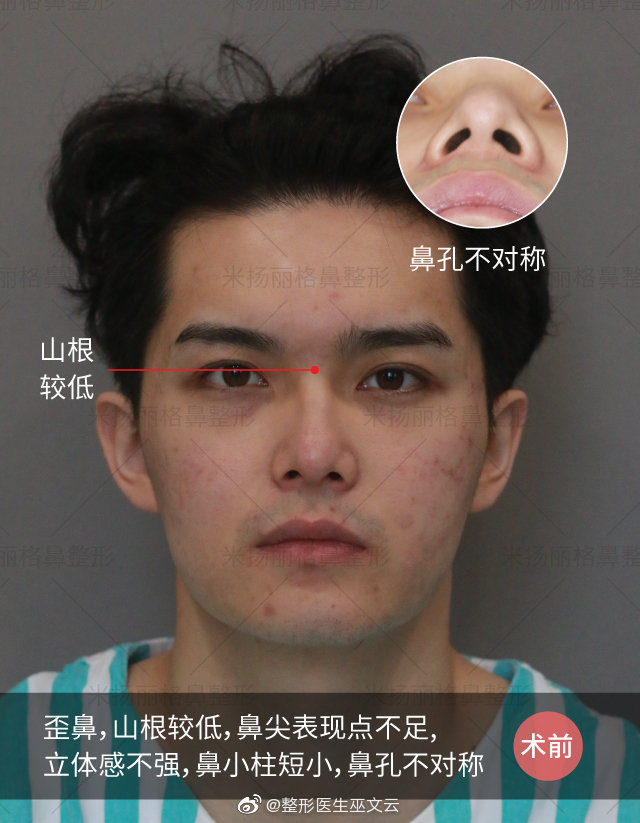 北京隆鼻修复最好的整形医生：巫文云和李劲良鼻修复哪个好？