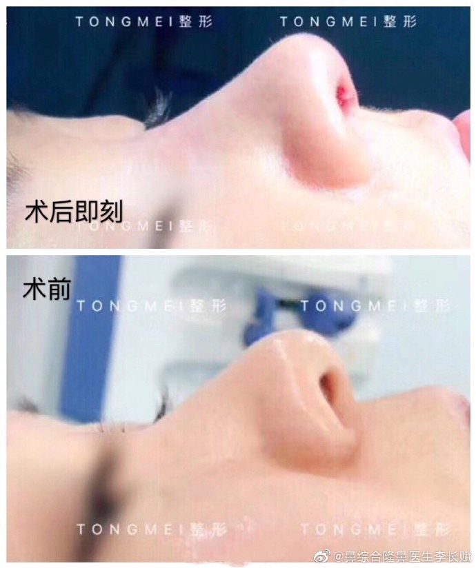 北京鼻综合最出名的专家：李劲良和李长赋哪个隆鼻鼻综合做得好？