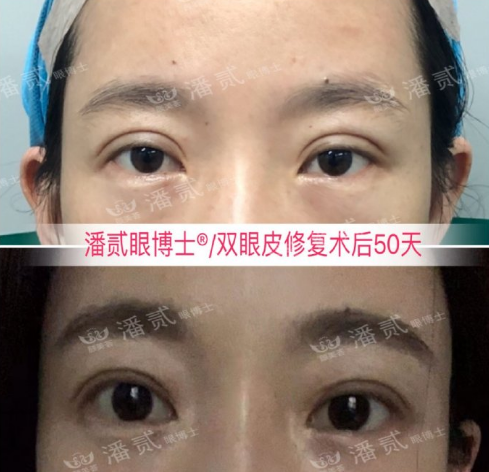 中国顶尖双眼皮修复专家：潘贰和田国静哪个修复双眼皮技术好？