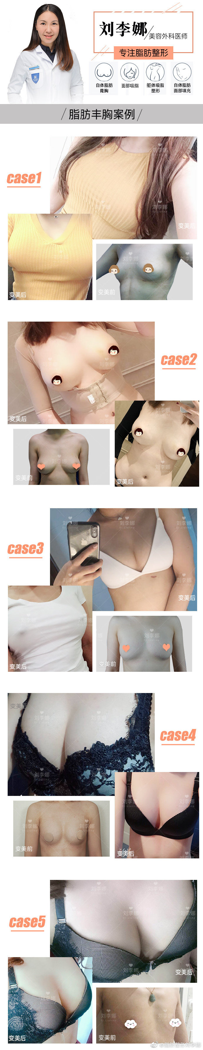 上海脂肪面部填充专家：百达丽刘李娜和上海华美王荣锡全面部填充谁更好？