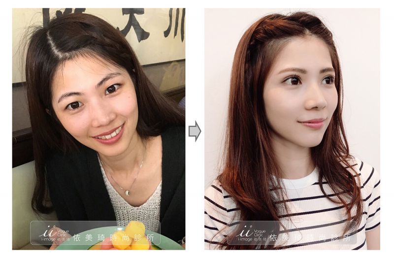 勾人电眼韩式双眼皮手术恢复期多久 韩式双眼皮案例