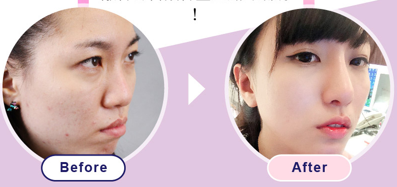 什么是韩式隆鼻？常见的隆鼻手术有哪几种？敲鼻骨鼻头鼻翼缩小
