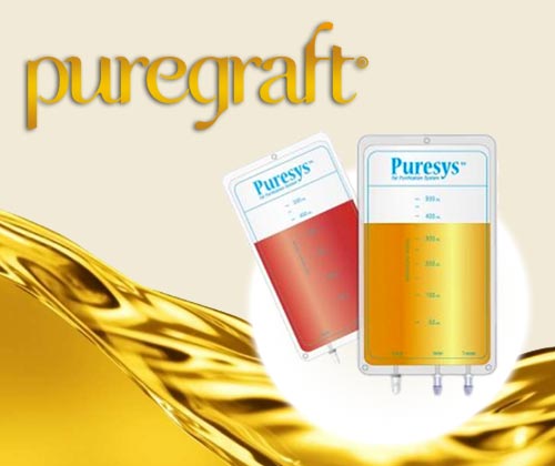 自体脂肪移植手术之Puregraft 黄金纯脂袋有哪些优点？