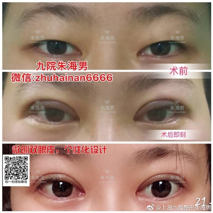 上海九院割双眼皮最好的专家顾斌朱海男朱惠敏苏薇洁金云波做眼睛谁厉害？