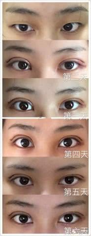 上海九院割双眼皮最好的专家顾斌朱海男朱惠敏苏薇洁金云波做眼睛谁厉害？