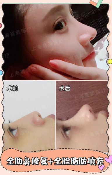 中国最好的做鼻子专家：王会勇和刘彦军（预约）谁的鼻子做得好？