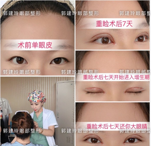 北京最好的眼综合医生是谁？北京做双眼皮眼综合医生哪个最好？