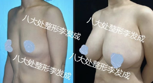 北京八大处脂肪丰胸隆胸多少钱？八大处做丰胸最好的医生是谁？