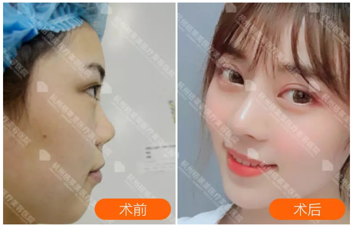 杭州鼻修复最好的医生有哪些？杭州隆鼻修复专家哪个口碑最好？