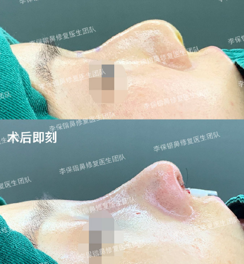 杭州鼻修复最好的医生有哪些？杭州隆鼻修复专家哪个口碑最好？