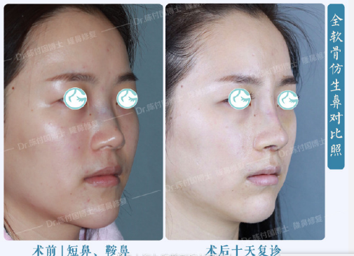 上海隆鼻鼻修复顶级专家推荐：王会勇和陈付国（预约）哪个医生做鼻子好？