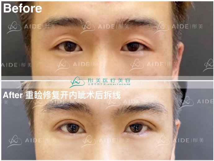 北京知名眼修复专家刘风卓（案例预约）双眼皮修复多少钱