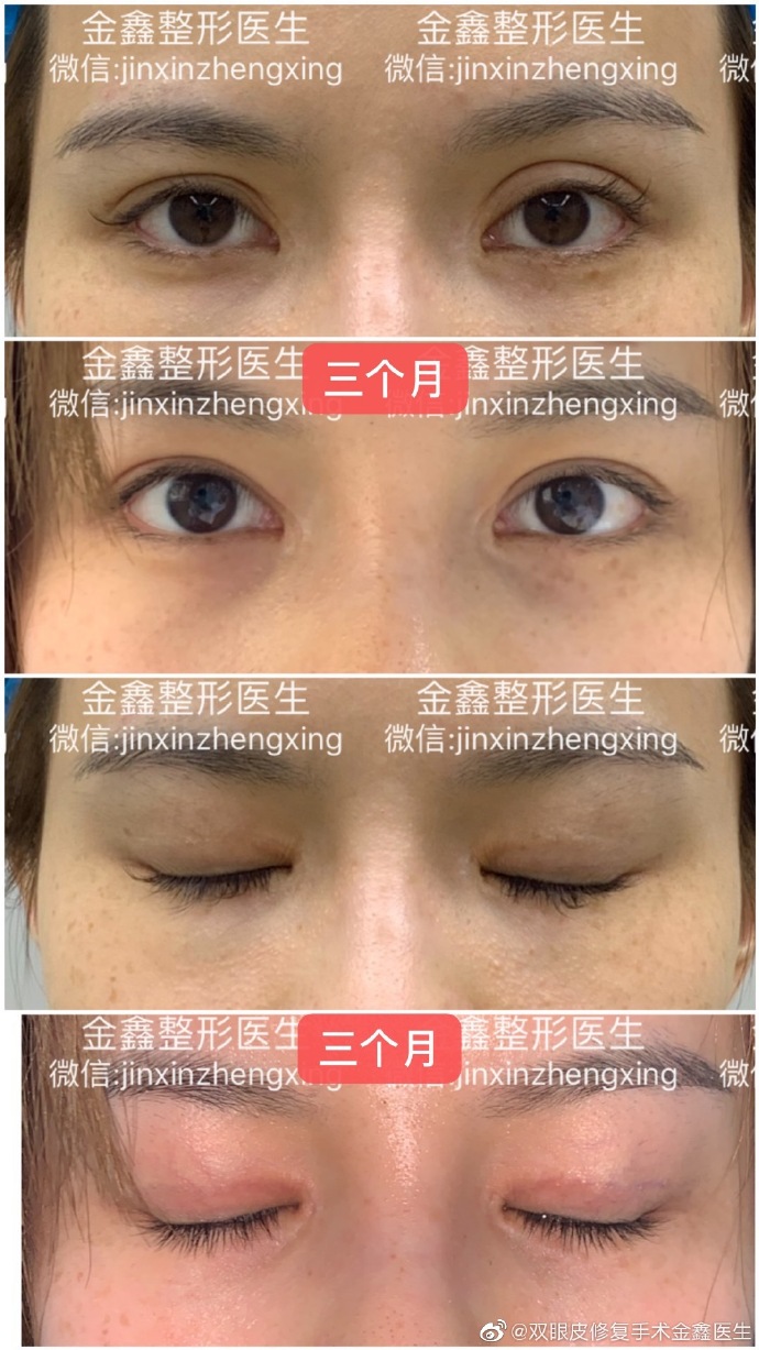 深圳金鑫（案例预约）双眼皮修复技术怎么样？