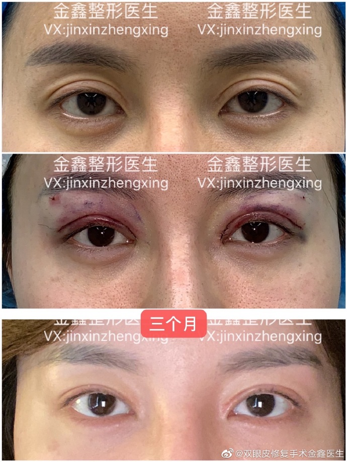 深圳金鑫（案例预约）双眼皮修复技术怎么样？
