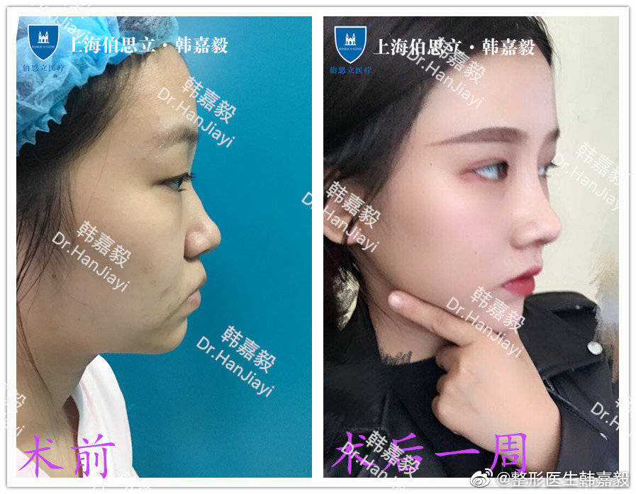 上海隆鼻专家：韩嘉毅和谢卫国哪个做小翘鼻好？