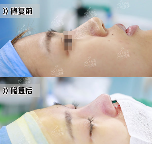 广州鼻综合专家推荐：罗延平和王世虎隆鼻&鼻综合哪个好？