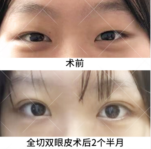 北京割双眼皮推荐：八大处于晓波和王太玲双眼皮&眼综合哪个好？