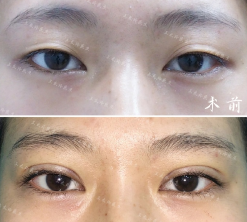 北京割双眼皮推荐：八大处于晓波和王太玲双眼皮&眼综合哪个好？