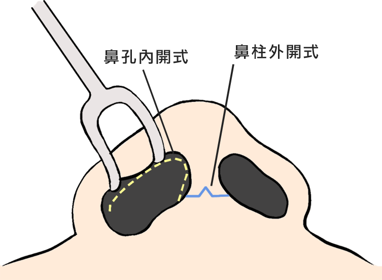 自体耳软骨隆鼻取出方法和切口位置在哪里？
