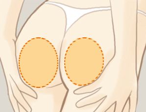 臀部整型的方法有哪些？抽脂丰臀电波拉皮丰臀人工丰臀术