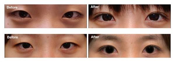 广州公立三甲医院割双眼皮眼综合好口碑医生有哪些？