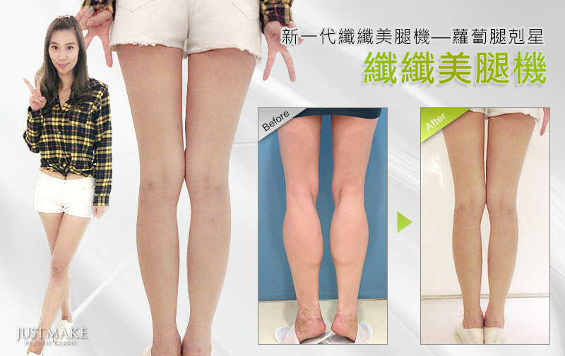 纤纤美腿雷射是什么意思？瘦小腿的效果好吗？
