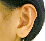 招风耳形成的原因是什么？招风耳的手术方式是什么？