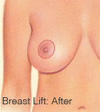 胸部下垂的手术方法有哪些？隆乳提乳提胸选择哪个？