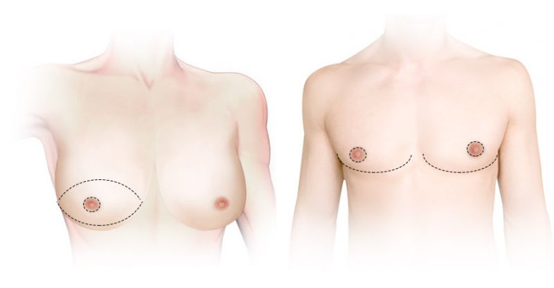 平胸手术( 缩胸手术) 的恢复期多久？平胸手术( 缩胸手术) 术后注意事项？