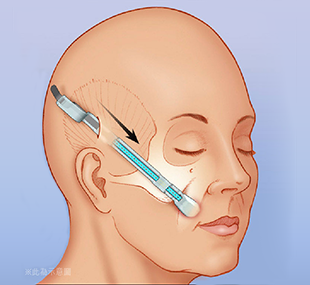 中下脸拉皮手术包括哪些部位？中脸拉皮中下脸拉皮颈部拉皮