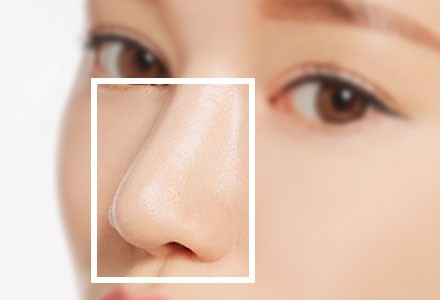 注射隆鼻填充包含哪几种？玻尿酸微晶瓷胶原蛋白自体脂肪隆鼻填充