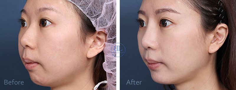 一般隆鼻与非正统韩式隆鼻和韩式结构式软骨隆鼻的优势