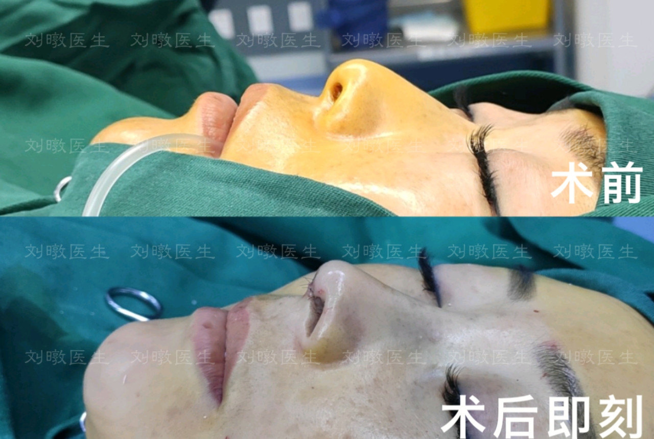 国内做鼻子最厉害的三甲医院医生：戴传昌和刘暾（预约案例）鼻综合哪个好？