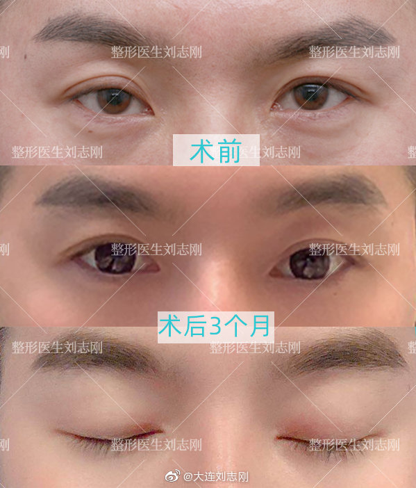 国内最好的修复双眼皮医生：双眼皮修复白永辉和刘志刚（预约）哪个手艺高？