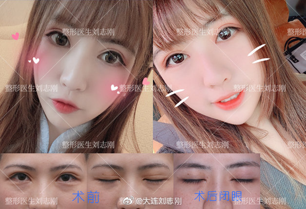 国内最好的修复双眼皮医生：双眼皮修复白永辉和刘志刚（预约）哪个手艺高？