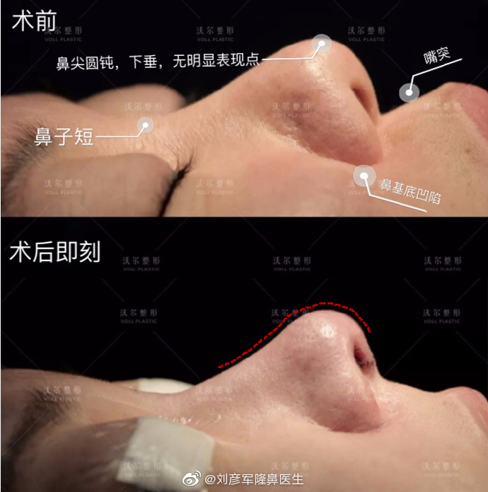 北京肋骨鼻做得比较好的医生:刘彦军王军巫文云薛志强李劲良（预约）肋骨隆鼻谁厉害？